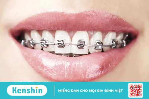 Gắn band niềng răng có đau không? Khi nào cần gắn band niềng răng