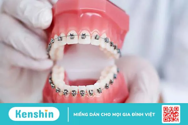 Gắn band niềng răng có đau không? Khi nào cần gắn band niềng răng 2