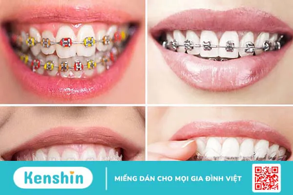 Gắn band niềng răng có đau không? Khi nào cần gắn band niềng răng 3