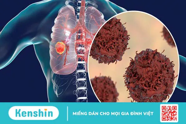 Gánh nặng ung thư toàn cầu trong bối cảnh hiện nay và dự kiến trong tương lai 2