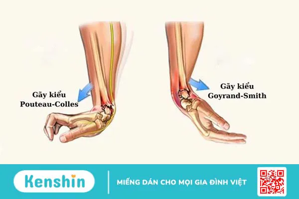 Gãy Goyrand Smith là gì? Nguyên nhân, triệu chứng và cách điều trị