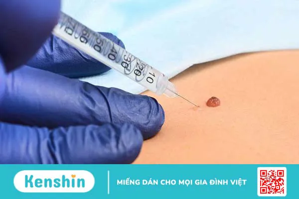 Gây tê là gì? Phân loại và các lưu ý cần biết