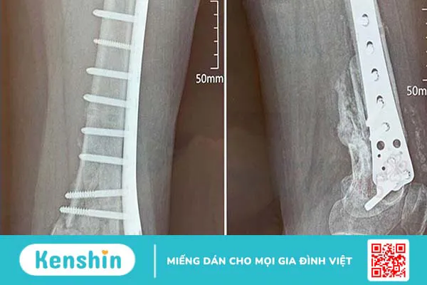 Ghép xương: Phương pháp khôi phục và tái tạo xương sau chấn thương