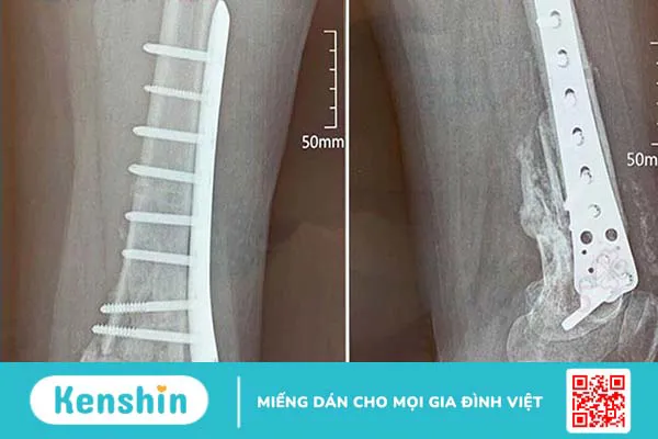 Ghép xương: Phương pháp khôi phục và tái tạo xương sau chấn thương 1