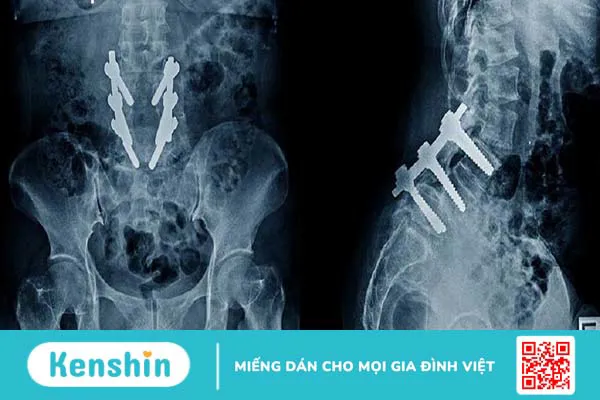 Ghép xương: Phương pháp khôi phục và tái tạo xương sau chấn thương 2