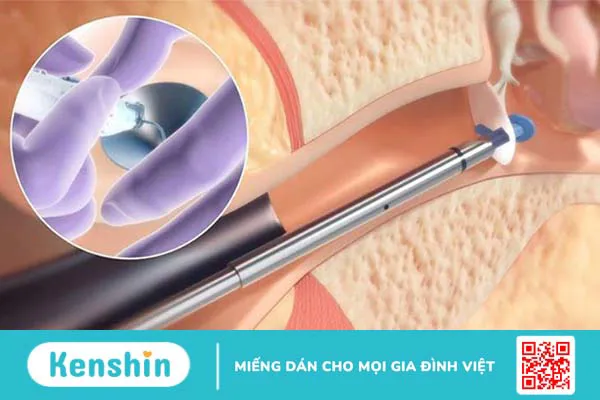 Giá đặt ống thông khí tai bao nhiêu tiền?