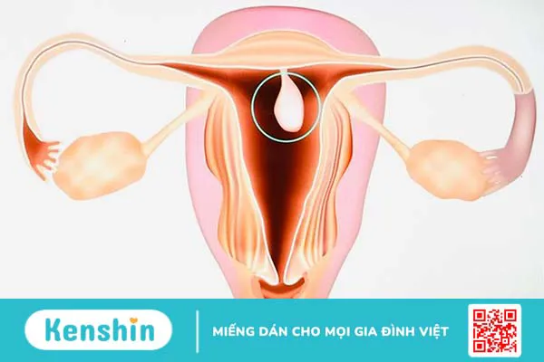 Giải đáp: 1 tháng có kinh 3 lần dấu hiệu của bệnh gì?