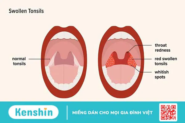 Giải đáp: Cắt amidan có ảnh hưởng đến giọng nói không?