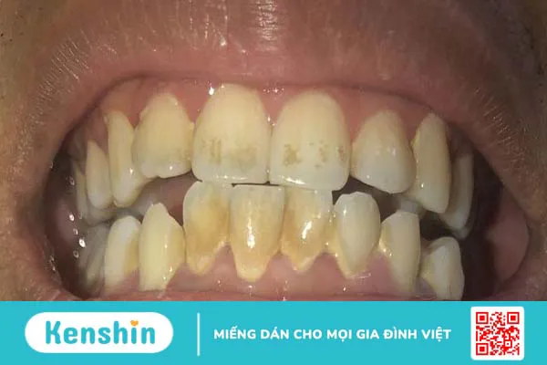 Giải đáp: Răng nhiễm kháng sinh có tẩy được không?