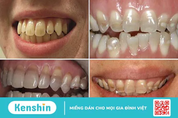 Giải đáp: Răng nhiễm kháng sinh có tẩy được không?