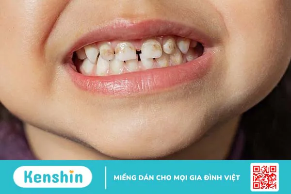 Giải đáp: Răng nhiễm kháng sinh có tẩy được không?