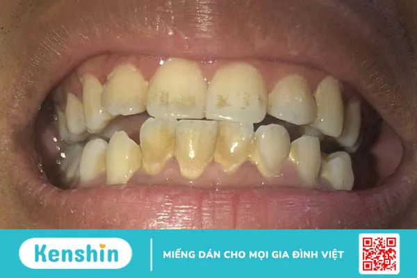 Giải đáp: Răng nhiễm kháng sinh có tẩy được không?