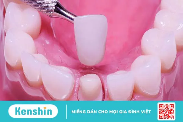 Giải đáp: Răng nhiễm kháng sinh có tẩy được không?