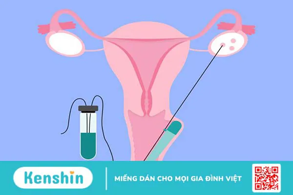 Giải đáp: Sau chọc hút trứng bao lâu thì quan hệ được?