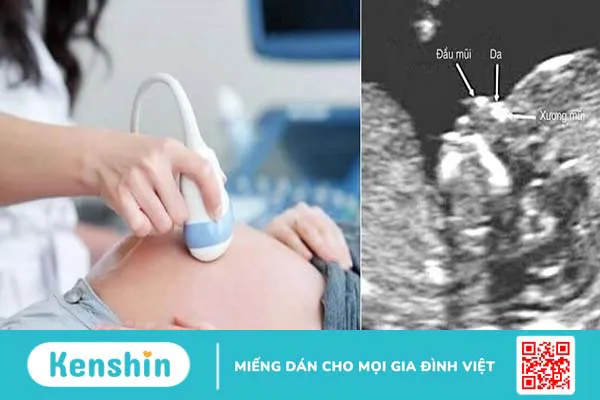 Giải đáp sức khỏe sinh sản: Không đo độ mờ da gáy có sao không?