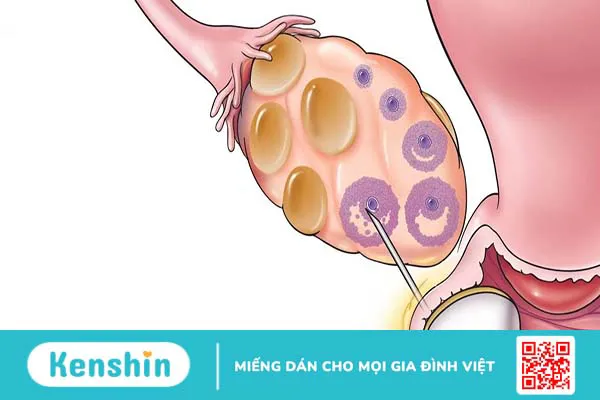 Giải đáp thắc mắc: Chi phí chọc hút trứng hết bao nhiêu tiền?