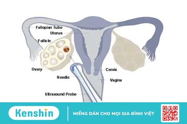 Giải đáp thắc mắc: Chi phí chọc hút trứng hết bao nhiêu tiền?