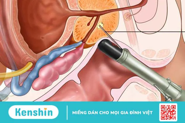 Giải đáp thắc mắc: Sinh thiết tuyến tiền liệt bao lâu có kết quả? 3