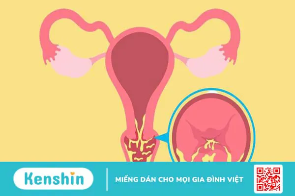 Giải đáp thắc mắc: Viêm lộ tuyến có gây ung thư không?