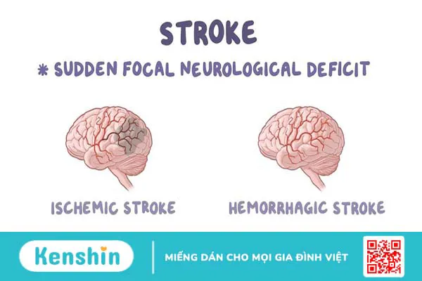 Giải đáp: Vì sao hút thuốc lá gây đột quỵ?