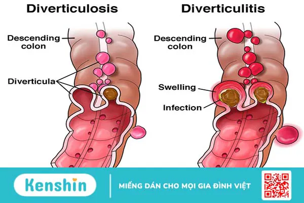 Giải đáp: Viêm túi thừa đại tràng kiêng ăn gì? 2