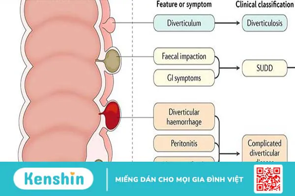 Giải đáp: Viêm túi thừa đại tràng kiêng ăn gì? 3