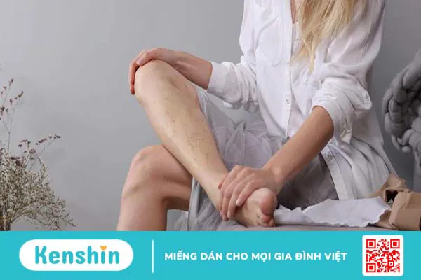 Giãn tĩnh mạch có nên đạp xe không? 1