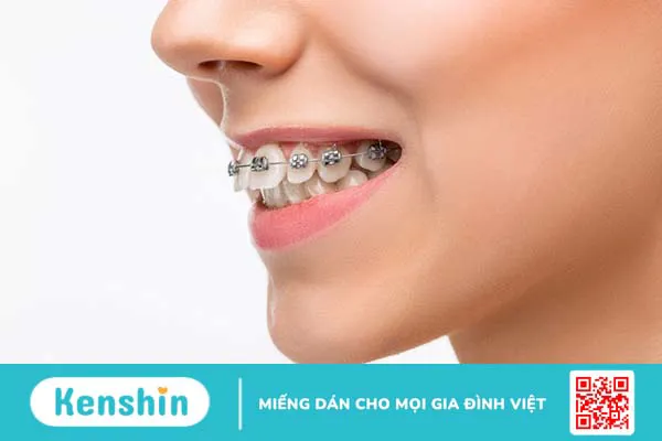 Giai đoạn đóng khoảng trong niềng răng được thực hiện như thế nào?