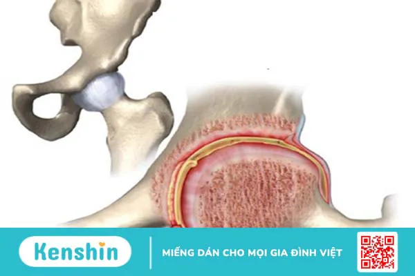 Giải phẫu cơ khớp háng và những bệnh lý thường gặp