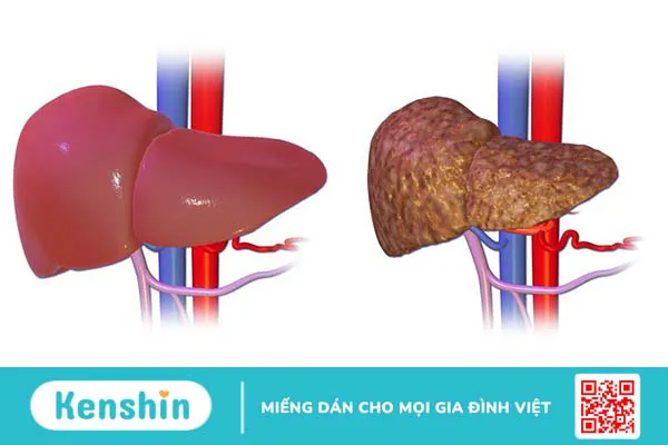 Giải phẫu gan và các bệnh lý về gan thường gặp