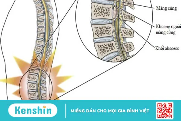 Giải phẫu khoang ngoài màng cứng và các ứng dụng lâm sàng