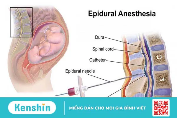 Giải phẫu khoang ngoài màng cứng và các ứng dụng lâm sàng