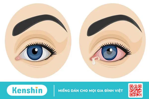 Giải phẫu mắt và các bệnh lý về mắt 5