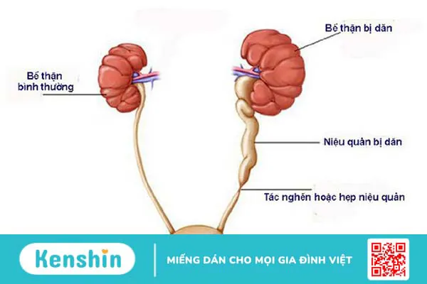 Giải phẫu niệu quản: Vị trí, cấu tạo, chức năng và bệnh lý liên quan 3