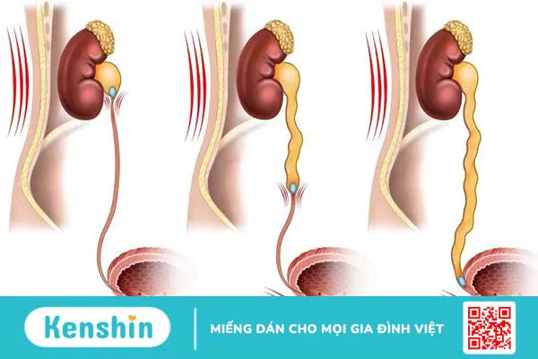 Giải phẫu niệu quản: Vị trí, cấu tạo, chức năng và bệnh lý liên quan 2