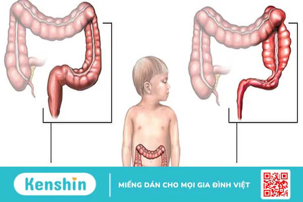 Giãn đại tràng bẩm sinh ở trẻ em: Nguyên nhân, triệu chứng và cách điều trị