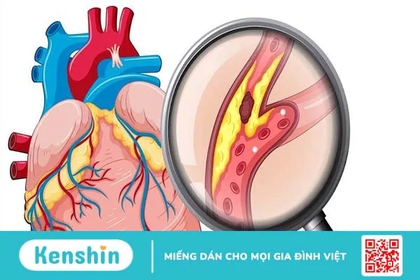 Giãn động mạch vành là gì? Triệu chứng, cách điều trị và phòng ngừa bệnh