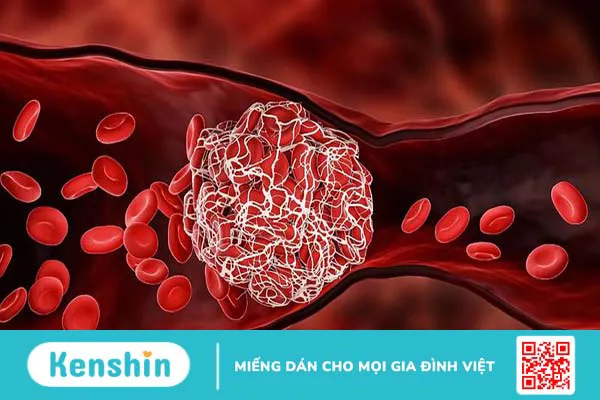 Giãn động mạch vành là gì? Triệu chứng, cách điều trị và phòng ngừa bệnh