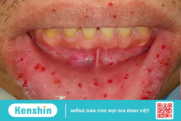 Bệnh di truyền hiếm gặp: Giãn mao mạch bẩm sinh xuất huyết 3