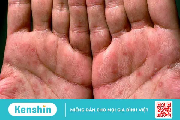 Giang mai kín là gì và các giai đoạn phát triển bệnh?