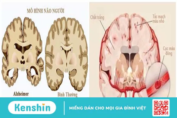 gioi-thieu-ve-sa-sut-tri-tue-cach-dieu-tri-va-phong-tranh4.webp