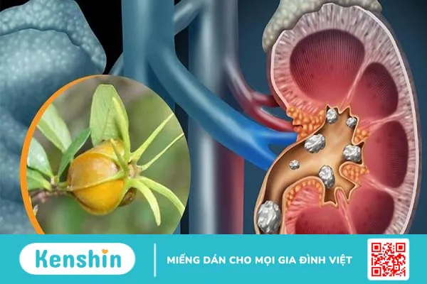 Góc giải đáp: Viêm cầu thận mạn sống được bao lâu?