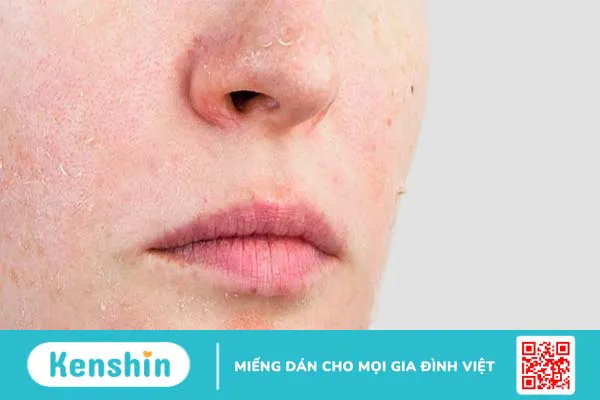 Gợi ý cách chăm sóc da nhạy cảm vào mùa đông