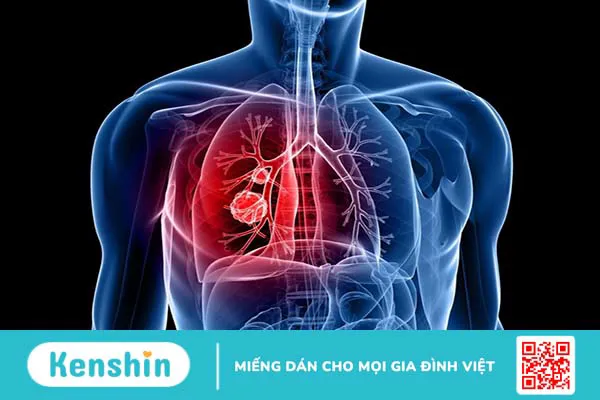 Hạch ở phổi có nguy hiểm không? Nguyên nhân và phương pháp điều trị 1