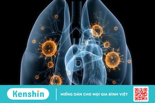 Hạch ở phổi có nguy hiểm không? Nguyên nhân và phương pháp điều trị 2