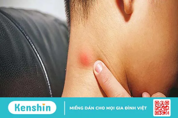 Giải đáp hạch thượng đòn bị viêm có gây nguy hiểm không? 2