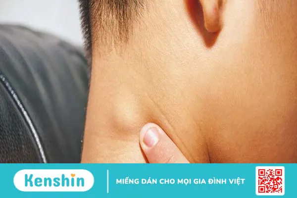 Hạch viêm quá sản là gì? Triệu chứng nhận biết và phương pháp điều trị ra sao?