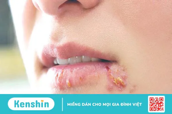 Hạch viêm quá sản là gì? Triệu chứng nhận biết và phương pháp điều trị ra sao? 2