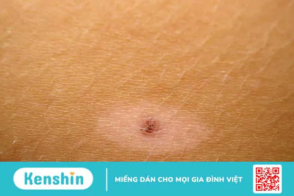 Halo nevus: Nguyên nhân, triệu chứng và cách điều trị