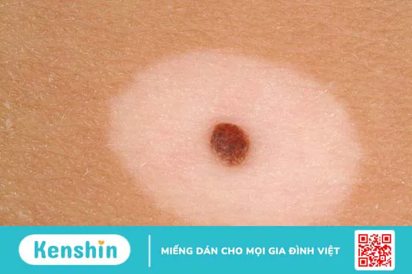 Halo nevus: Nguyên nhân, triệu chứng và cách điều trị